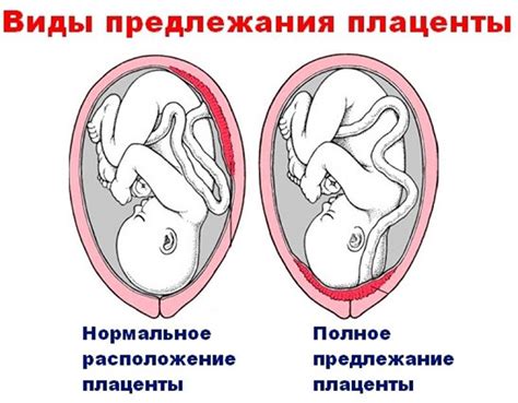 Как происходит предлежание хориона?