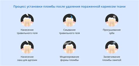 Как происходит формирование пломбы с кариесом?