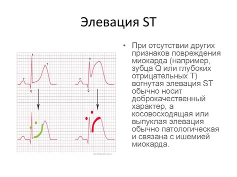 Как проявляется конкордантный подъем сегмента ST?