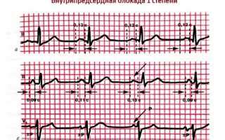 Как проявляется нарушение предсердной проводимости?