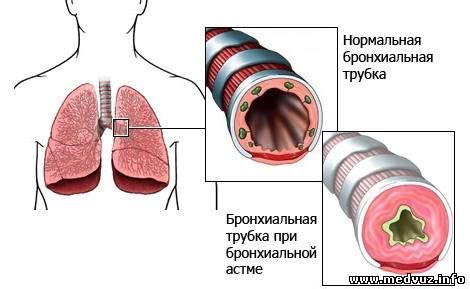 Как проявляется немое легкое