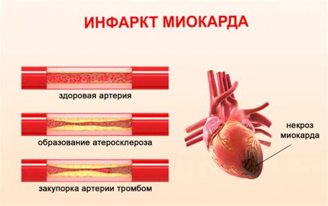 Как проявляется рубцовое поражение миокарда