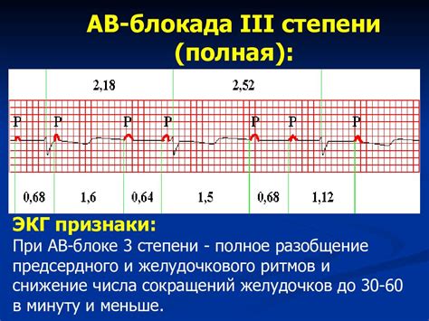 Как проявляется транзиторная ав блокада 1 степени?