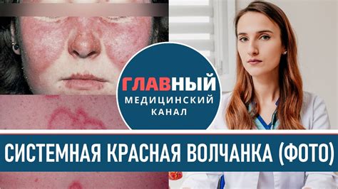 Как проявляются симптомы волчанки