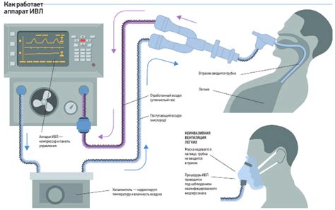 Как работает ИВЛ через трахею?