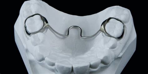 Как работает небный бюгель в ортодонтии?