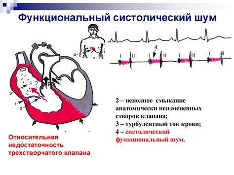 Как распознать систолический шум сердца?