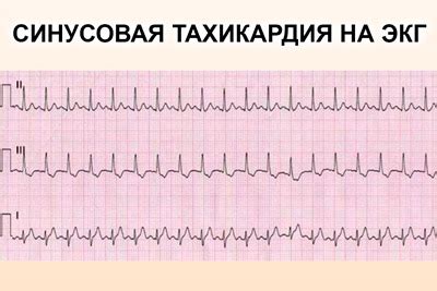 Как расшифровывается синусовая тахикардия по кардиограмме