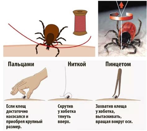 Как удалить застрявшую головку клеща из кожи человека?