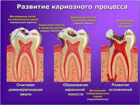 Кариес и пародонтит