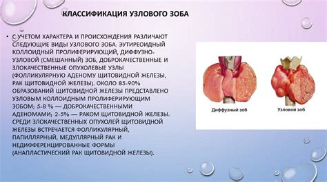 Категории и причины зоба узлового кистозного
