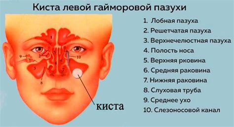 Киста правой гайморовой пазухи