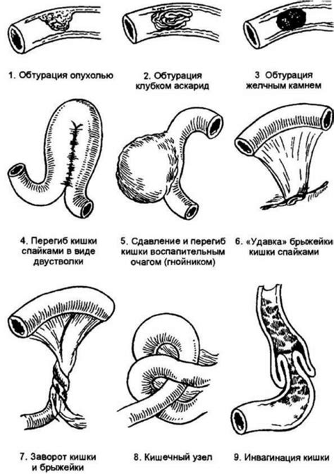 Кишечная непроходимость у новорожденных