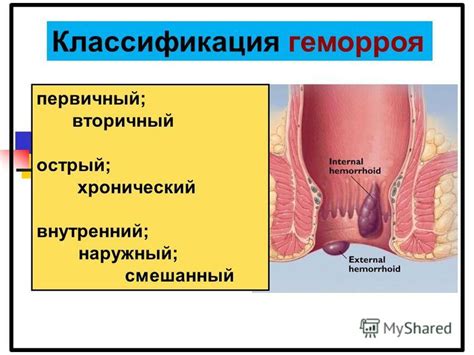 Классификация геморроя и его степени