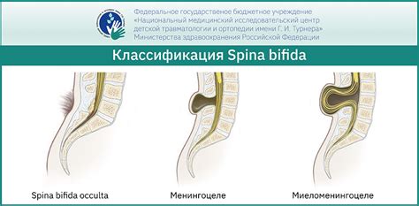 Классификация спина бифида S1