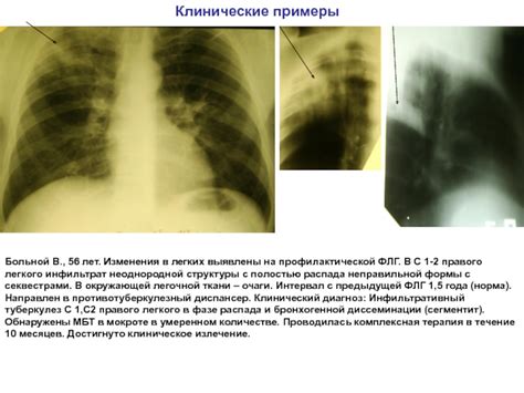 Клиническое излечение туберкулеза легких: