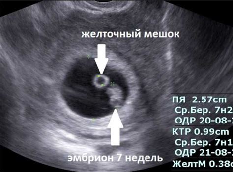 Когда можно увидеть эмбрион на УЗИ: на какой неделе гестационного возраста становится видна хгч