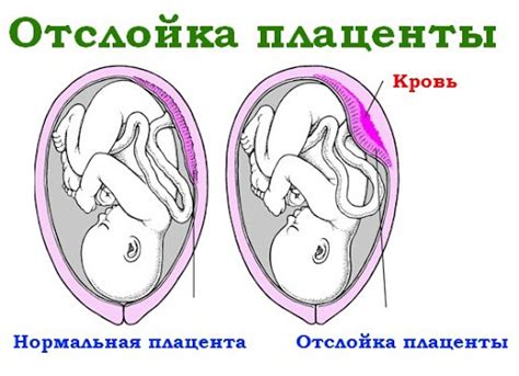 Когда начинается первая стадия зрелости плаценты