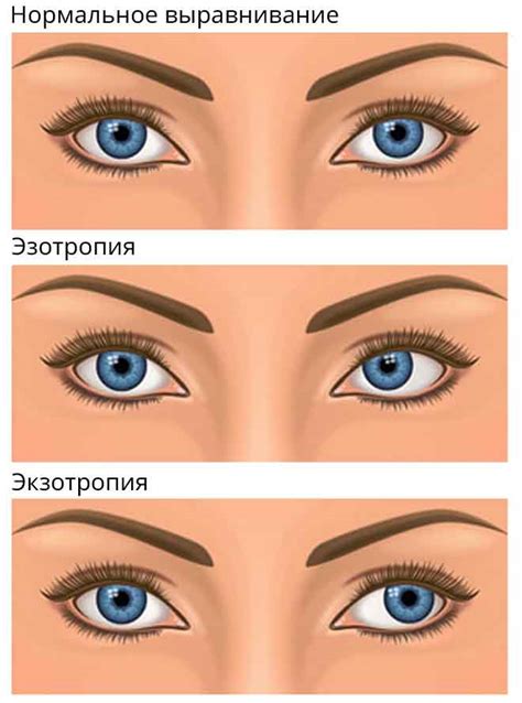 Когда обратиться к врачу, если появляется двоение в глазах?