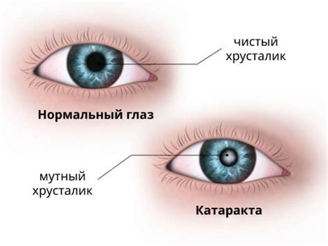 Когда приходит время принять решение: основные показания к удалению катаракты и замене хрусталика