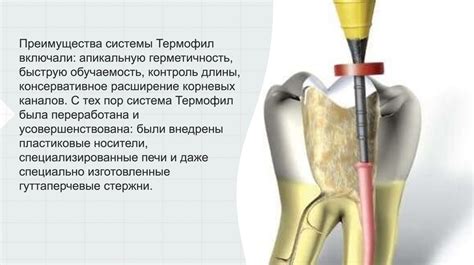 Когда требуется пломбирование корневого канала?