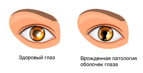 Колобома глаза: виды и характеристики