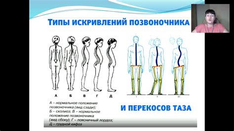 Компенсаторные изменения при перекосе таза