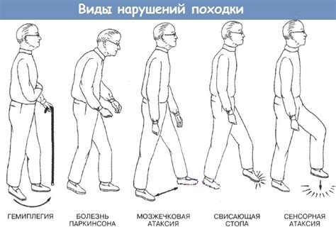 Комплексное лечение макаронной походки