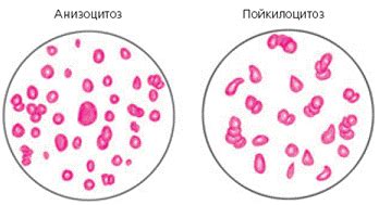 Компликации гипохромии анизоцитоза эритроцитов