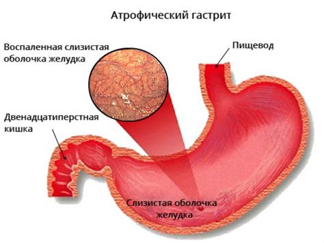 Компликации при гиперемии слизистой желудка