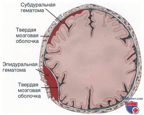 Компликации эпидуральной гематомы