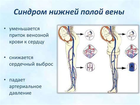 Консервативное лечение коллапса нижней полой вены