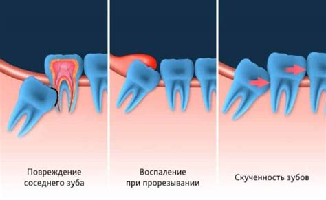 Контактный зуб: роль и значение