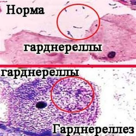 Контакт с инфицированным орошением