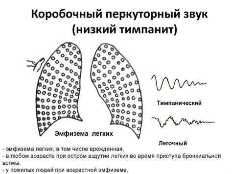 Коробочный звук при перкуссии: особенности и причины