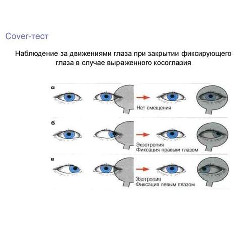 Коррекция глазного косоглазия у взрослых