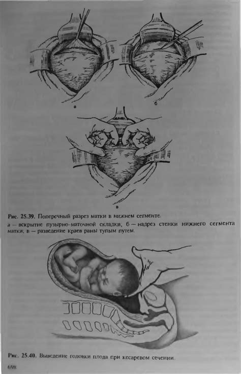 Косметический шов при кесаревом сечении