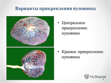 Краевое прикрепление хориона на 13 неделе