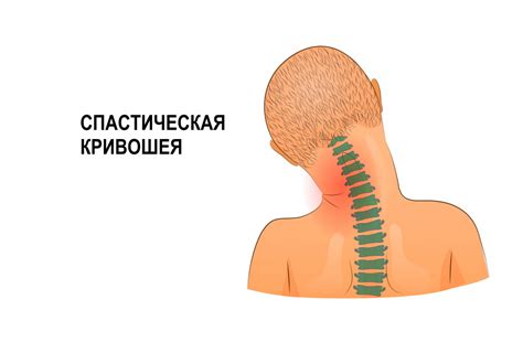 Кривошея: понятие, причины и способы лечения