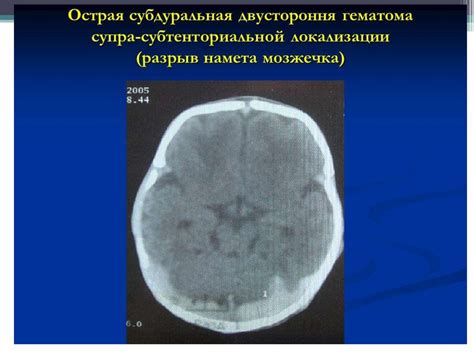 Кровоизлияние внутри черепа: самая опасная форма кровоизлияния у новорожденных