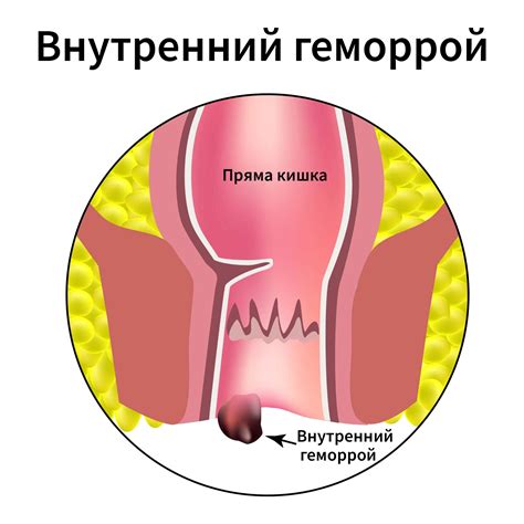 Кровоточащий геморрой: причины, симптомы, лечение