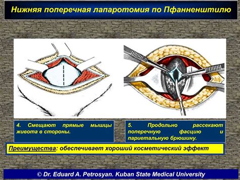 Лапаротомия по Джоэлу Коэну: все, что нужно знать