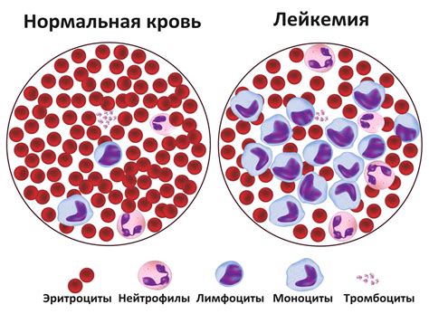 Лейкемия: определение и симптомы