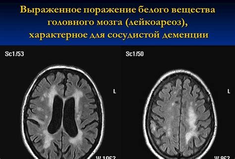 Лейкоареоз головного мозга: сущность и причины