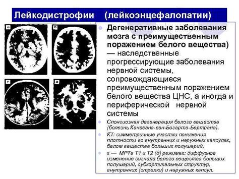 Лейкоэнцефалопатия сосудистого генеза