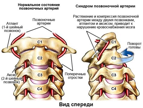 Летальные исходы от Лск по позвоночным артериям