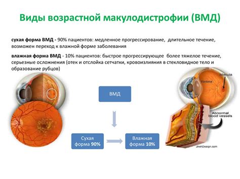 Лечение ВМД глаза