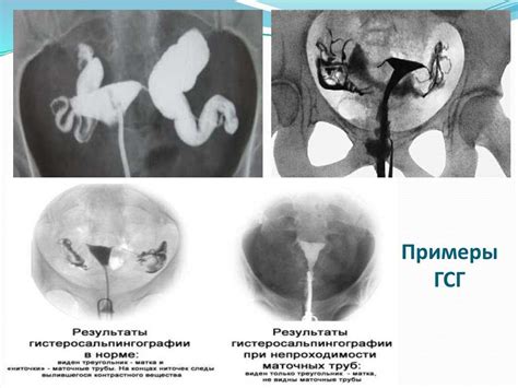 Лечение ГСГ маточных труб