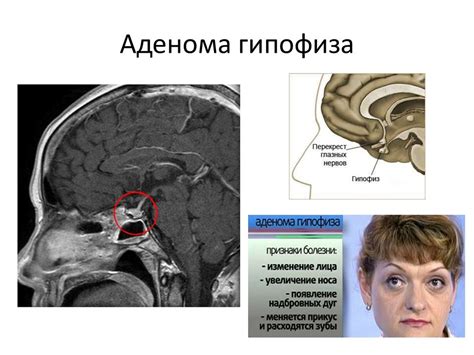 Лечение аденомы гипофиза