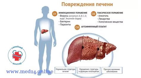 Лечение алкогольного цирроза печени